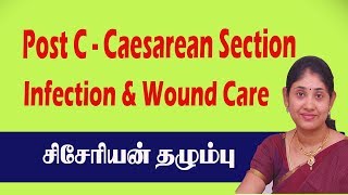 Post C Caesarean Section Delivery Surgery Severe Pain Infection ampWound Care சிசேரியன் தழும்பு புண் [upl. by Chan]