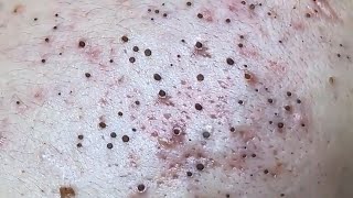 Blackheads amp Whiteheads Satisfying Removal 0027 [upl. by Annek901]