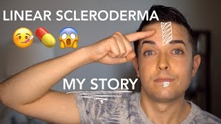 Linear Scleroderma En Coup De Sabre  My Story [upl. by Ateekahs]