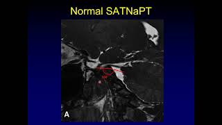 Journal Club Sagittal Angle in Trigeminal Neuralgia [upl. by Ylrad]