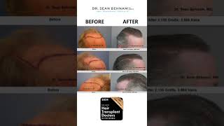 Gray hair transplant performed by Dr Sean Behnam [upl. by Gnoud819]