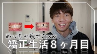 8ヶ月間歯列矯正した経過と感想を語ります。 [upl. by Riabuz]