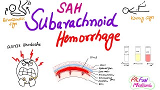 Subarachnoid Hemorrhageberry aneurysmSAHNeurosurgery [upl. by Anirehtac]