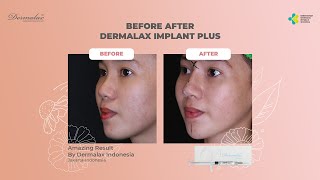 DERMALAX IMPLANT PLUS AREA TREATMENT NOSE AND CHIN [upl. by Eednas]