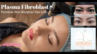 Plasma Fibroblast Non Surgical Blepharoplasty Eyelift Treatment amp Training Singapore [upl. by Airakaz476]