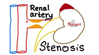 Renal Artery Stenosis [upl. by Erna]