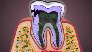 What is Pulpitis [upl. by Sella]