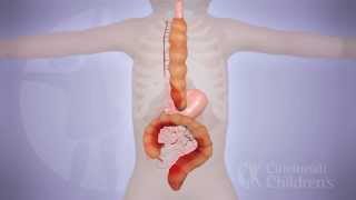 LongSegment Colonic Interposition for Esophageal Atresia 3D Animation [upl. by Nagear]