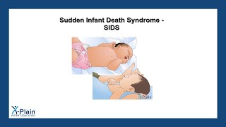 Sudden Infant Death Syndrome  SIDS [upl. by Sigismund173]