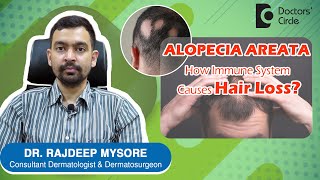 ALOPECIA AREATA amp Triggers How to prevent PATCHY HAIR LOSS  Dr Rajdeep Mysore  Doctors Circle [upl. by Nealon]