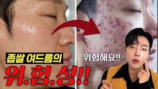 좁쌀여드름 예방amp박살내는 방법│좁쌀여드름의 위험성이벤트 있음 [upl. by Kcirredal773]