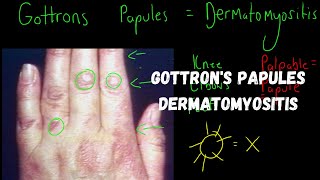 Gottrons Papules  Dermatomyositis [upl. by Beghtol]