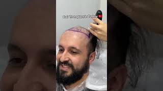 Hair Transplant in Turkey  Hair Transplant Process hairtransplant [upl. by Illak738]