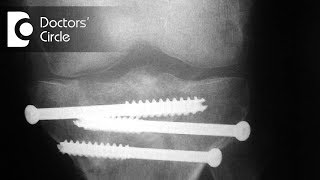 What is the effect of MRI on Internal Fixation Implants  Dr Mohan M R [upl. by Kinelski]