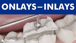 Dental inlays and onlays © [upl. by Jasen]