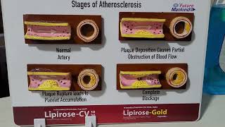 Stages of atherosclerosis [upl. by Mclaughlin950]