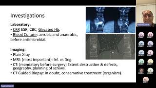 Strategies for Surgical Treatment of Neglected Spondylodiscitis Hazem Elsebaie FRCS MD [upl. by Grosberg]