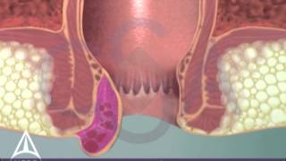 Thrombosed External Hemorrhoid  3D Medical Animation [upl. by Mcadams365]