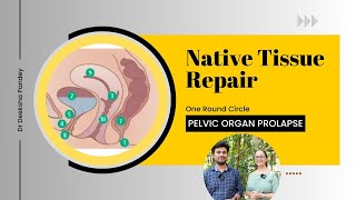 Native Tissue Repair  Pelvic organ prolapse  NTR [upl. by Slaohcin]