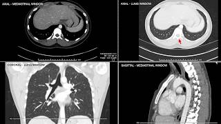 Introduction to Computed Tomographic imaging of the Chest [upl. by Lativa971]