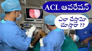 ACL ligament reconstruction surgery technique  Telugu  Dr Ramprasad kancherla [upl. by Lavro]