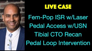 LIVE CASE FemPop ISR Pedal Access and Tibial amp Pedal Loop Intervention [upl. by Jorey615]