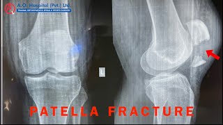 Fracture of the PATELLA  Tension Band Wiring [upl. by Ainud]