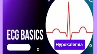 ECG changes in Hypokalemia Causes of Hypokalemia [upl. by Karie]