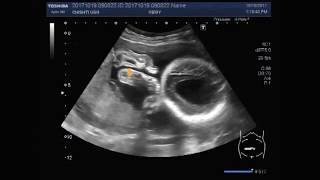 Ultrasound Video showing hydrocephalic fetus [upl. by Townshend]