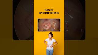 Bowel Endometriosis Symptoms BowelEndometriosisEndometriosisChronicPainEndometriosisAwareness [upl. by Selway]