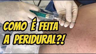 COMO É FEITA A PERIDURAL E QUAIS AS SUAS INDICAÇÕES [upl. by Helsell]