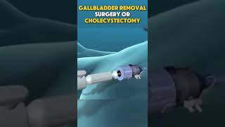 GALLBLADDER REMOVAL SURGERY OR CHOLECYSTECTOMY [upl. by Norga31]