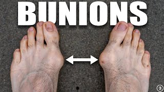 Bunions  Hallux Valgus Diagnosis Exercises Treatment [upl. by Norad]