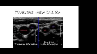 Carotid Doppler ultrasound [upl. by Halford]