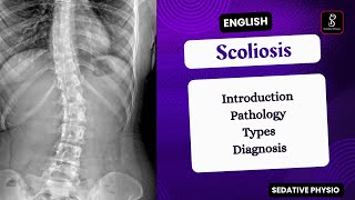 Scoliosis  Types Pathology Clinical Features  Orthopedic deformity  Sedative Physio [upl. by Nmutua872]