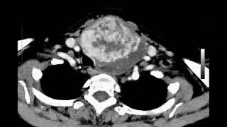 CAT Scan of a Very Large Goiter in the Left Thyroid [upl. by Lozano]