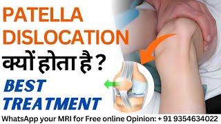 Patella Subluxation Dislocation क्यों होता है  MPFL Injury Causes amp Best Treatment [upl. by Schoening615]