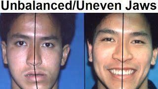 Orthodontic Treatment of Asymmetrical Unbalanced Disproportionate or Unequal Jaw by Dr Mike Mew [upl. by Beitnes]