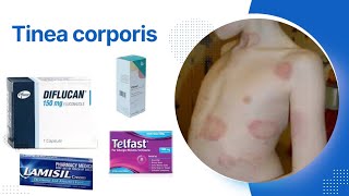 شرح التينيا tinea corporis [upl. by See]