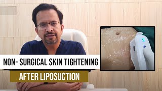 Will Skin Sag After A Liposuction  Non Surgical Skin tightening after liposuction [upl. by Luis]