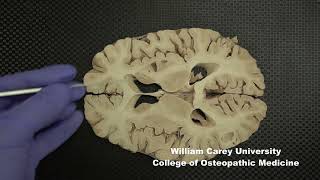 Horizontal slices of human forebrain neuroanatomy forebrain internal capsule caudate nucleus [upl. by Llig]