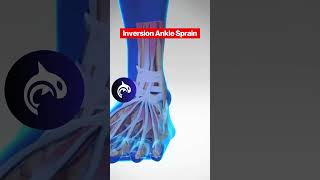 See the difference between both Eversion and Inversion Ankle Sprains in 3D Animation [upl. by Nawaj]