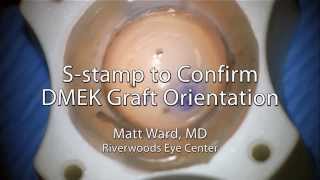 DMEK S Stamp to Confirm Graft Orientation [upl. by Taddeusz]