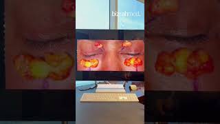 Eye bagsFullness Removal Dr Bashar BizrahLondonDubai  836 [upl. by Lorita]