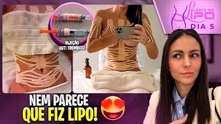 5 DIÁRIO DE LIPO MINHA RECUPERAÇÃO 😱😍  falando tudo [upl. by Atsejam768]