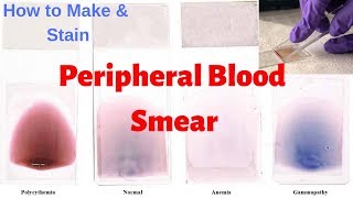 Peripheral Blood Smear Peripheral Smear Examination  Leishmans Staining Procedure [upl. by Yattirb]