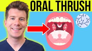 Doctor explains ORAL THRUSH Oral Candidiasis  Symptoms treatment amp prevention in adultsbabies [upl. by Halfdan195]