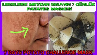 LEKELERE MEYDAN OKUYAN 7 GÜN PATATES MASKESİ  DOĞAL CİLT BAKIMI [upl. by Hanley67]