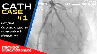 Cath Case 01 Angiography amp Angioplasty  Interpretation and Management  Bifurcation Stenting [upl. by Onirefes705]