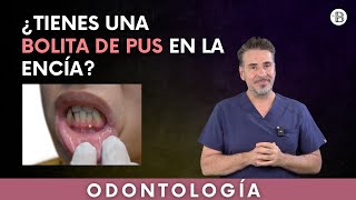 ¿Tienes una BOLITA DE PUS en la ENCÍA ¡Descubre qué es💡 [upl. by Stillmann]